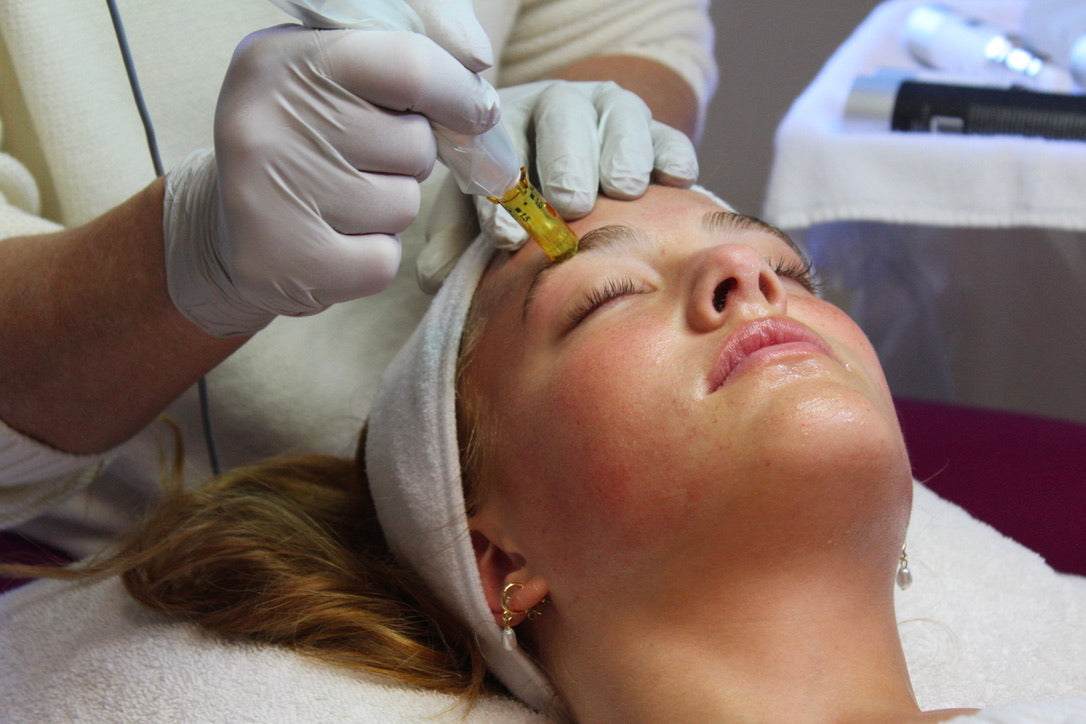 At-Home vs Professional Microneedling : Compared