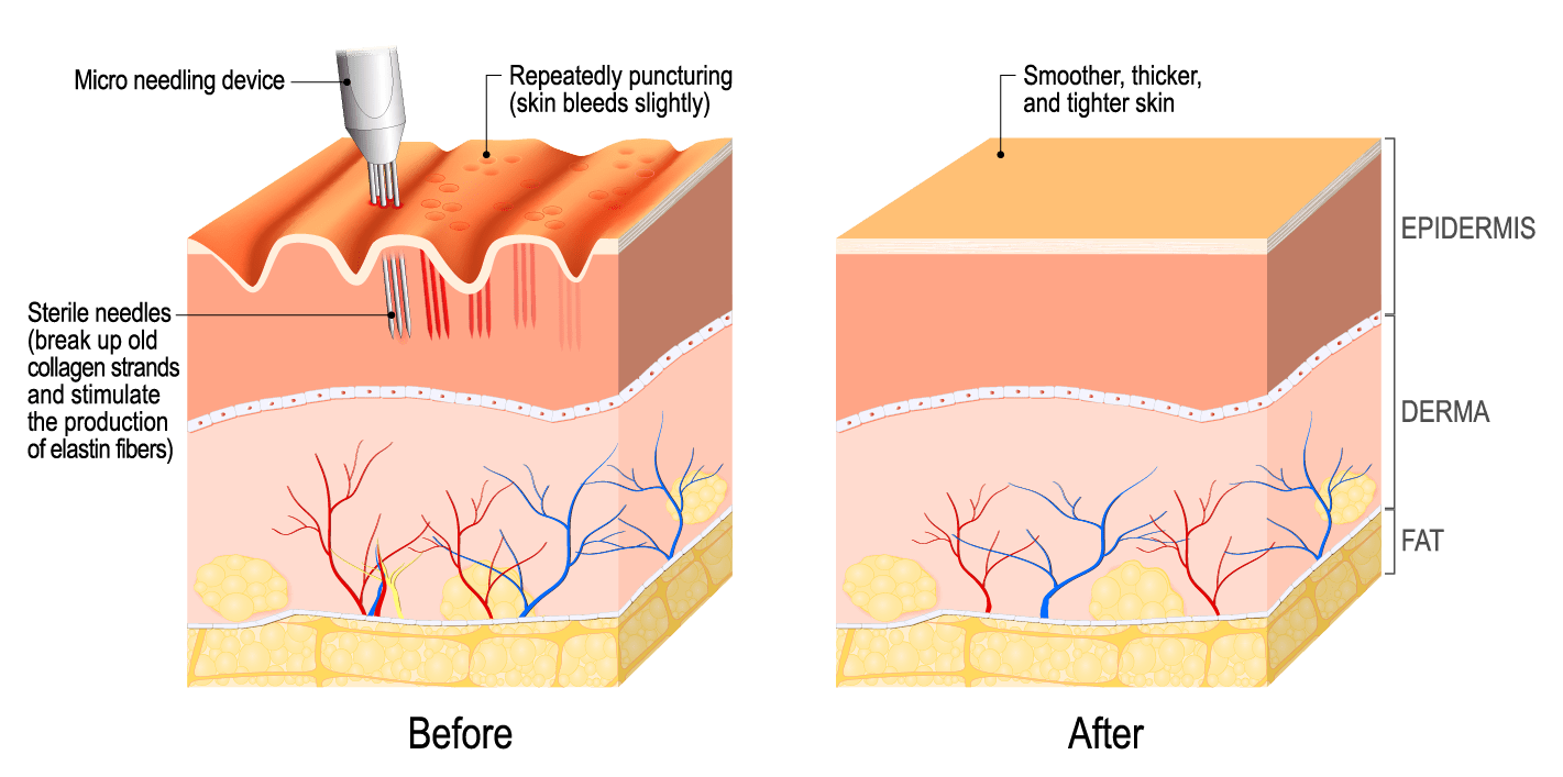 Is Microneedling Effective?