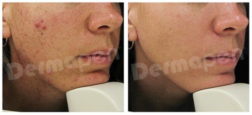 Acne scarring before and after