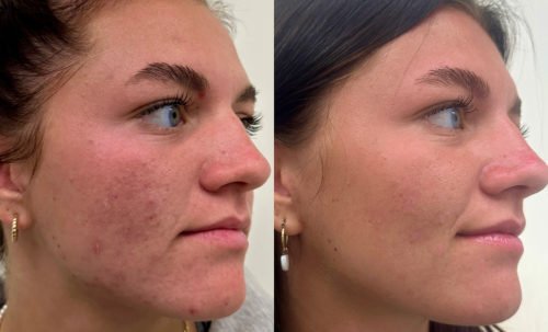 Before and after image of acne and acne scarring improvement