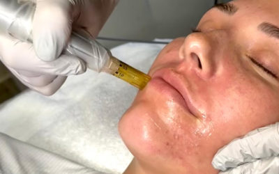Close up image of woman receiving a microneedling treatment