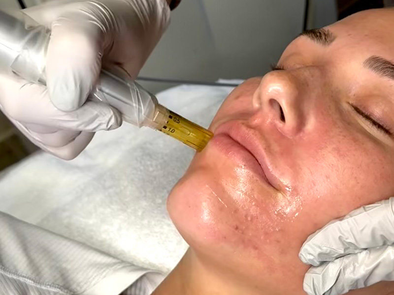 Close up image of woman receiving a microneedling treatment